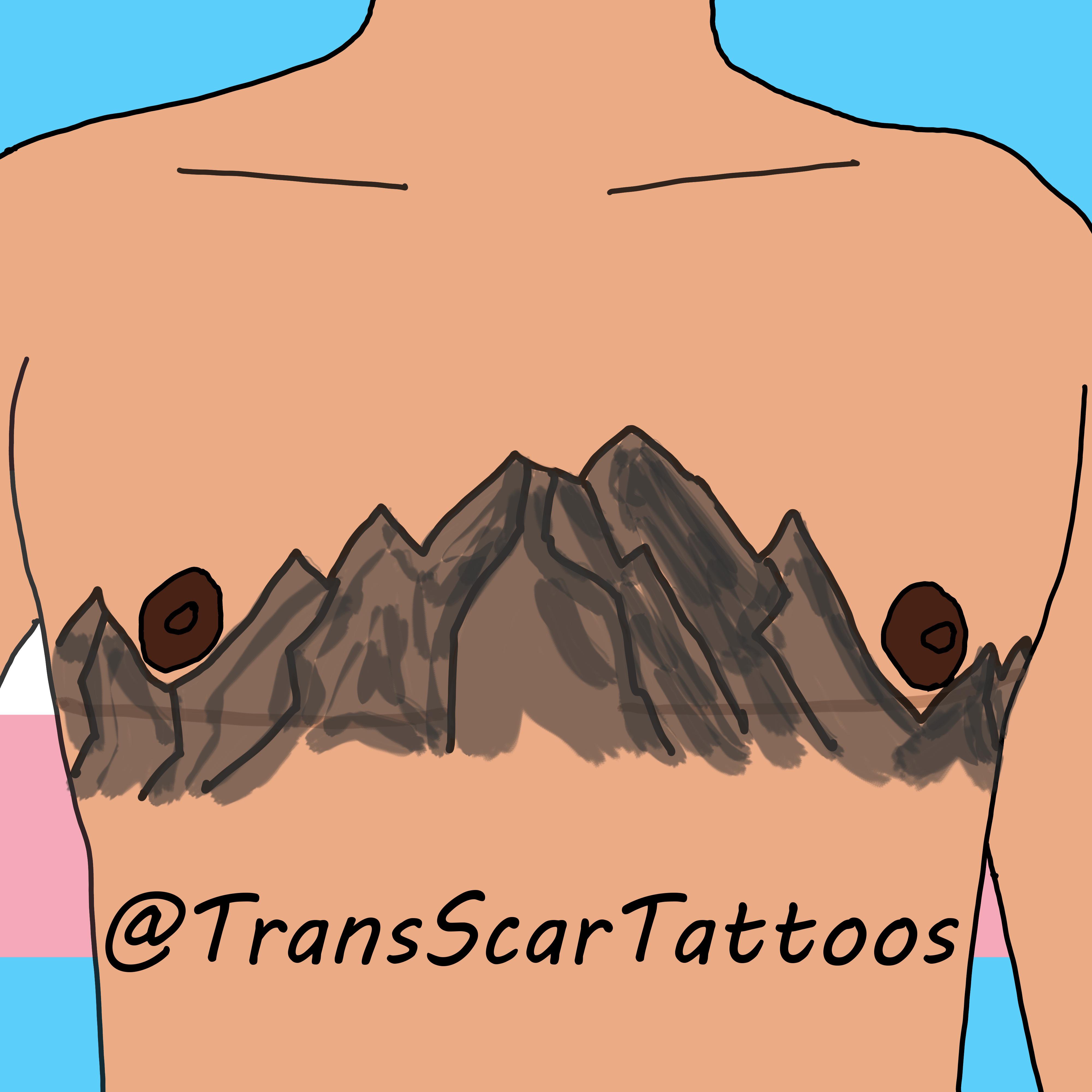 Scar Reduction FTM Top Surgery Bilateral Mastectomy Breast Removal 2   Stretch Mark Treatment Scars Dry Tattooing Permanent Makeup Saline  Tattoo Removal in Manchester